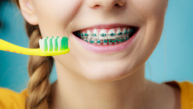 How Much Do Braces Cost on Average?